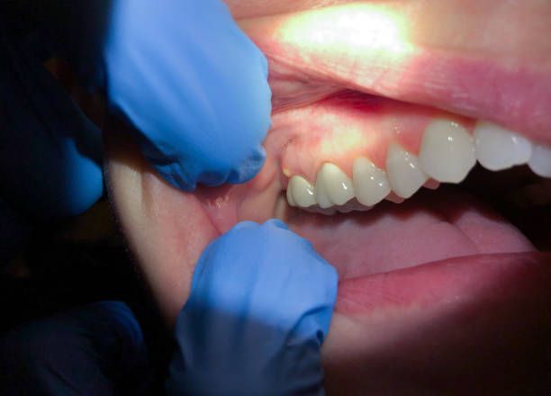 Best Emergency Wisdom Tooth Extraction in Springfield, MA